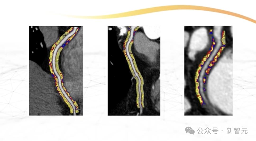 AI视觉算法登柳叶刀!看CT提前10年预测致命心脏疾病,已进入临床使用
