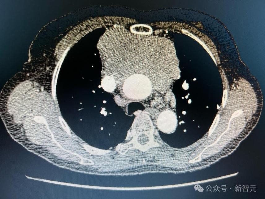 哈佛推出全新类ChatGPT癌症诊断AI,登上Nature,准确率高达96%